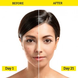 Chemist At Play Acne Control Serum - 30ml (10% Azelaic Acid + 10% Niacinamide) Chemist At Play Acne Control Serum - 30ml (10% Azelaic Acid + 10% Niacinamide)